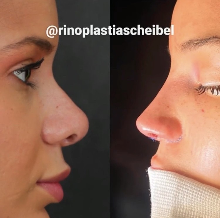 Jacqueline and Mariano show off the results of their rhinoplasty (Image: Reproduction/Instagram)
