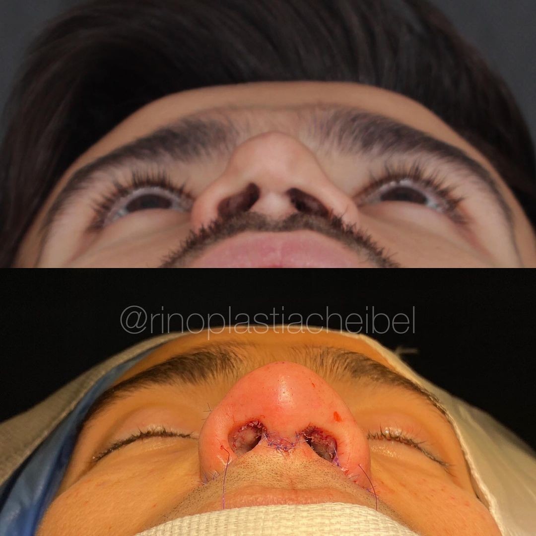 Jacqueline and Mariano show off the results of their rhinoplasty (Image: Reproduction/Instagram)