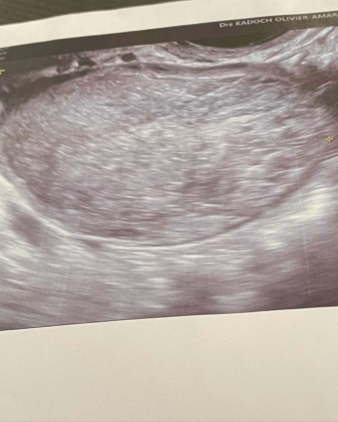 Thylane Blondeau undergoes surgery (Image: Engage/Instagram)