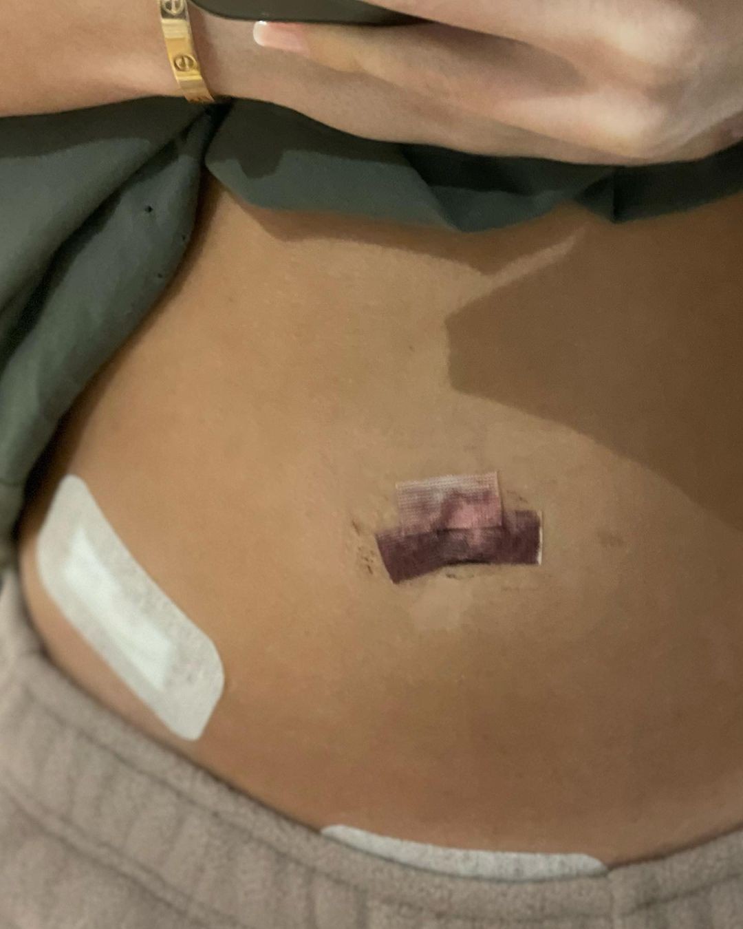 Thylane Blondeau undergoes surgery (Image: Engage/Instagram)
