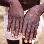 US distributes monkeypox vaccines to the most vulnerable populations |  Globalism