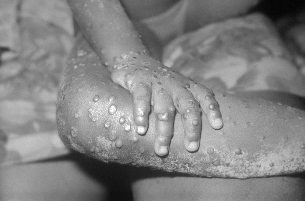 Monkeypox: Risk of spread in Nigeria but low in UK, says WHO |  Health