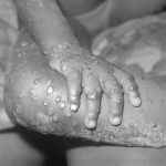Monkeypox: Risk of spread in Nigeria but low in UK, says WHO |  Health