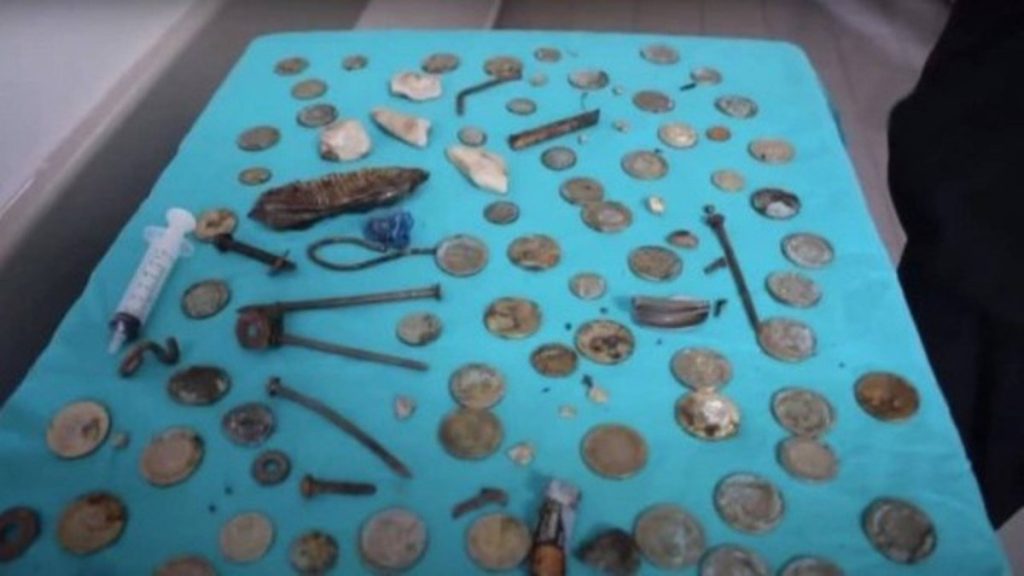 Batteries and coins: Doctors remove 233 pieces of patient's stomach |  extraordinary world
