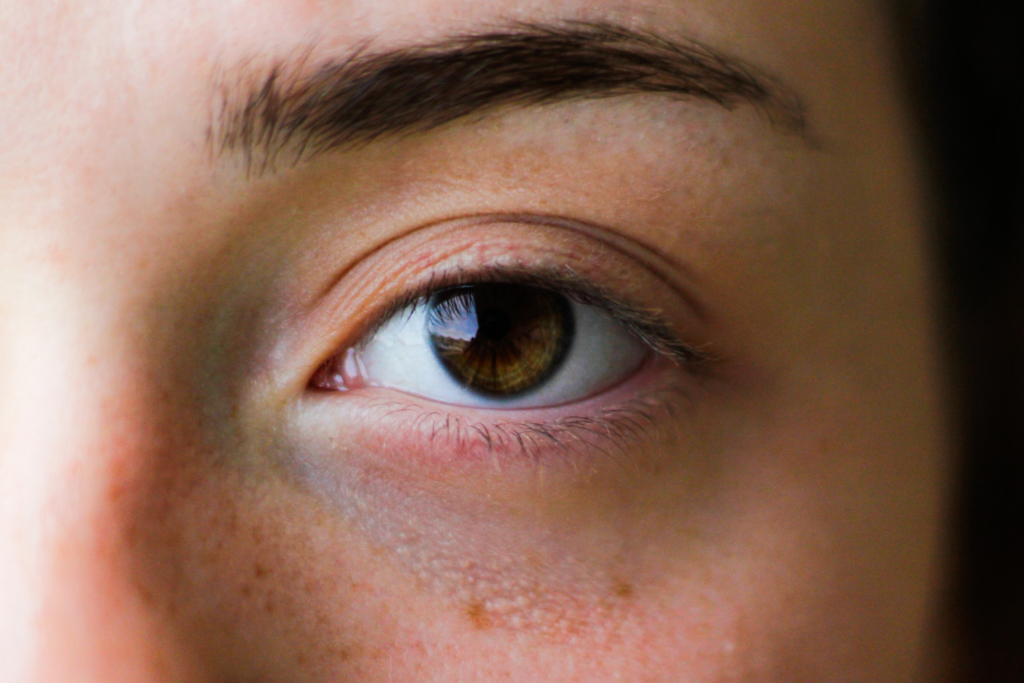 Do you have any marks in your eye?  Find out what it could be